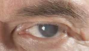Resultado de imagen para cataratas ojos
