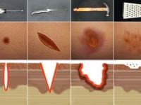 Tipos de Heridas
