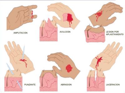 Tipos de heridas (Galería de&nbsp;imagenes)